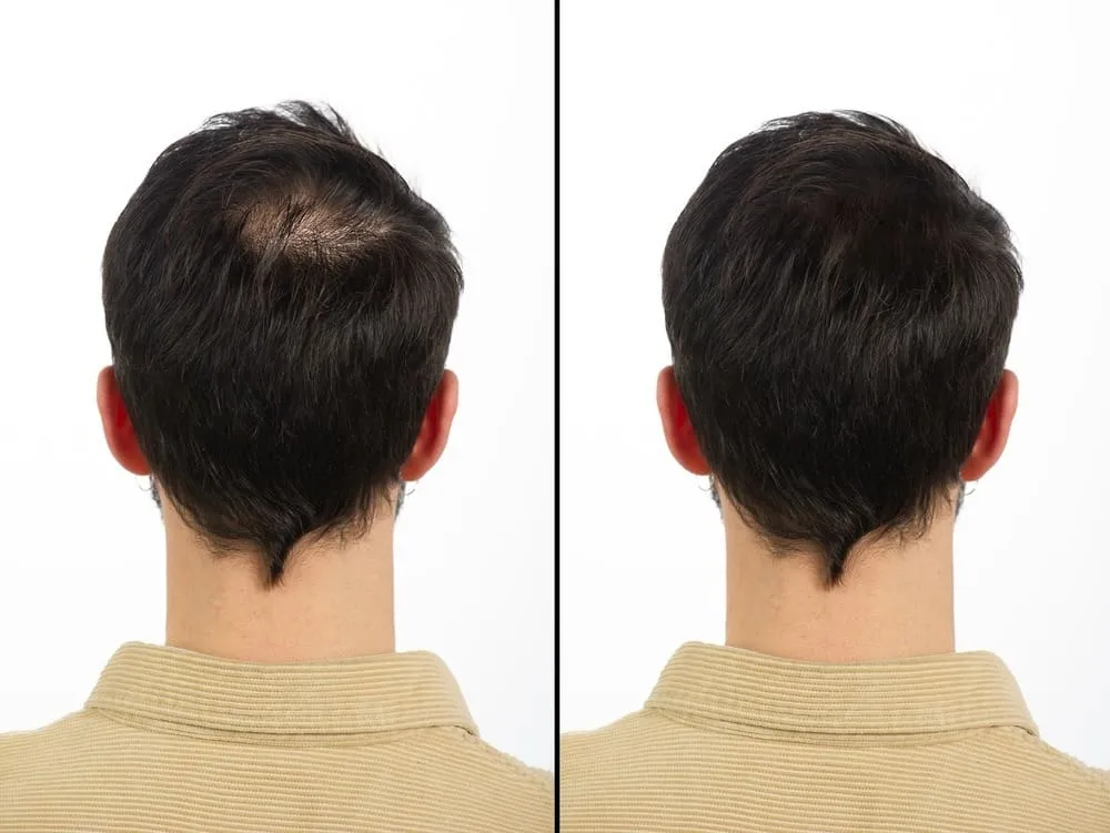 Hair Loss and Mental Health: How Alma TED™ Restoration Can Make a Difference - Blog