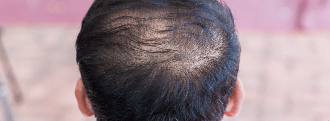 67ab746545f9f5ec5eee61c4 hair loss 2 3