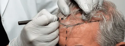 691c8f00293c7ea6589d35fe hair transplant 3