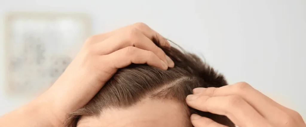 What to Expect After Your First Alma TED Hair Treatment - Blog