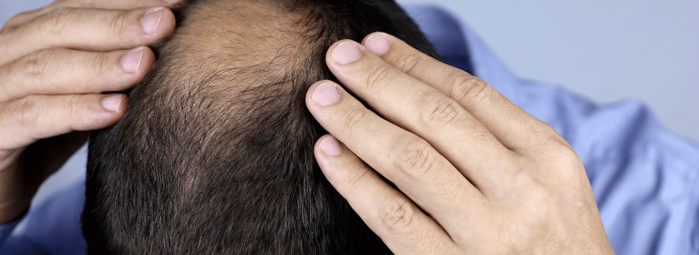 69babdd8f8c703464a75c4b1 682b49a59ad7e85704ffef94 male20pattern20baldness 3