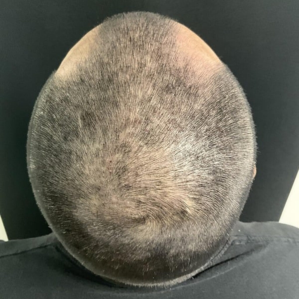 Shedding After Illness